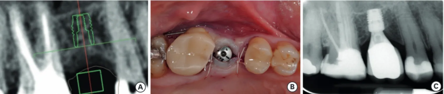 Figure 1. (A) A treatment option for the posterior maxilla with a vertical bone height of 6–8 mm