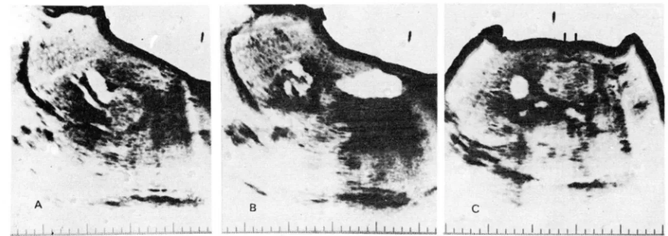 Fig. 1.  The  case  of  pancreatic  head  cancer;  We Il  defined  echogenic  mass  is  noted  in  head  of pancreas  with  marked  dilatation  of extrahepatic  bile  duct ,  obstructed  by  the  mass
