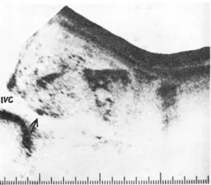 Fig. 6.  The  casc  of  acute  pancreatitis;  The  pancreas  is  markedly  swollen  and  the  echogenecit y  is  markedly decreased