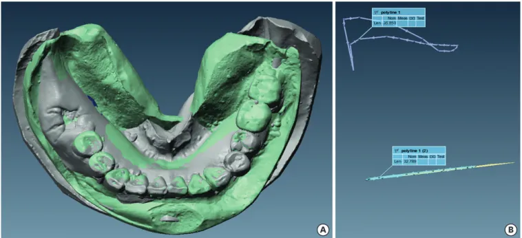 Figure 2. (A) Polyworks superimposition of cast scans. Adjacent teeth were used as reference points