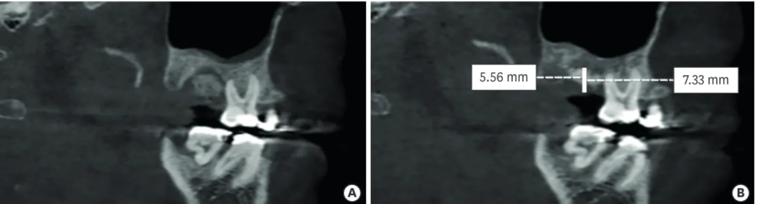 Figure 3. (A) The sagittal image of CBCT from V2. (B) Calculation of height in the V6 image, which was cut similarly to the V2 image