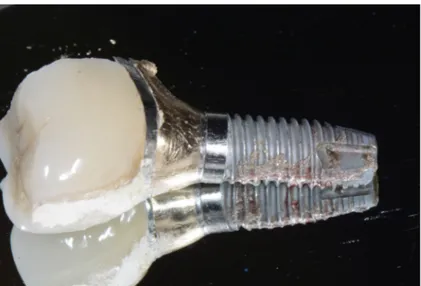 Figure 4. Implant removed for advanced peri-implantitis with a clear cement remnant visible on the prosthetic  crown.