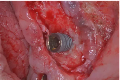 Figure 1. Class I-c peri-implant defect.