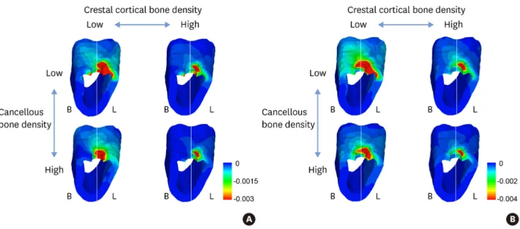 Figure 5. Minimum principal strain distribution in the cortical bone in 2.0-mm crestal cortical bone models