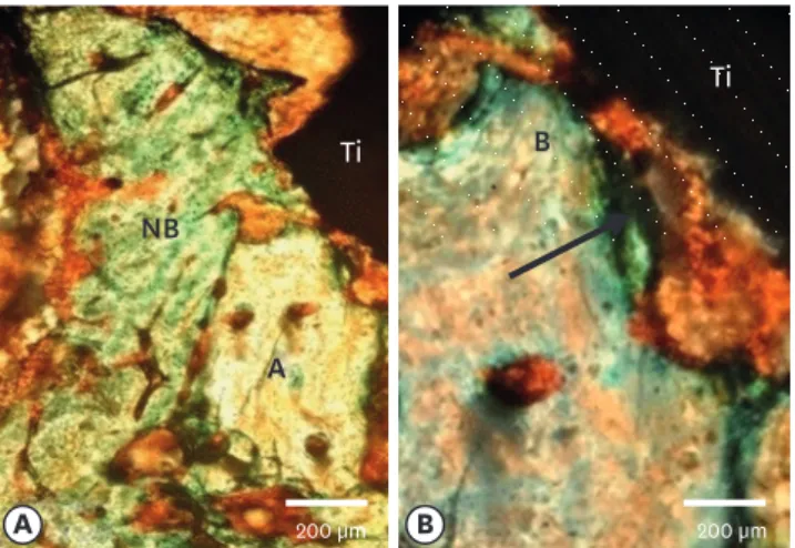 Figure 3. Interface bone-implant surface with mineralized bone cortical allograft particles without a membrane  3 months after implantation