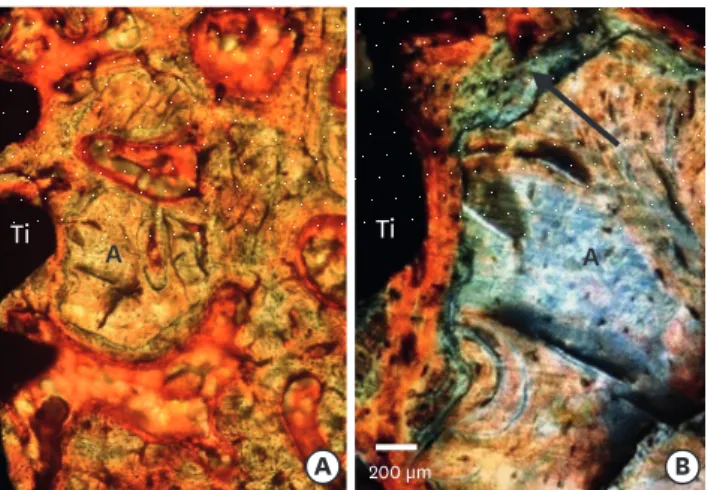 Figure 5. Bone-implant interface with mineralized bone cortical allograft particles and a membrane 3 months  after implantation