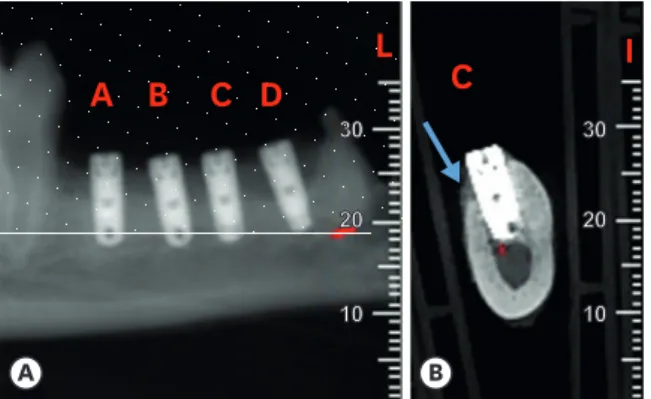 Figure 8. X-ray tomography at 3 months (S100%, intact socket). (A) Longitudinal view of 4 implants