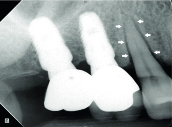 Figure 1. Radiograph of splinted dental implants in the maxillary posterior region and adjacent natural premolar  tooth