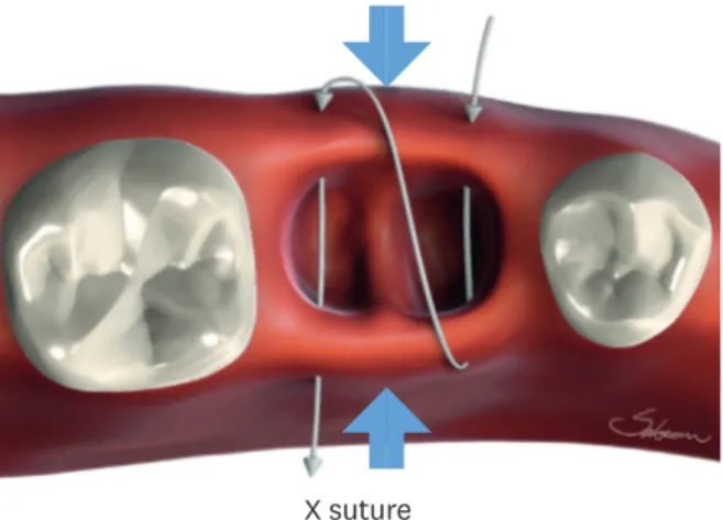 Figure 1. X suture or conventional X suture. The needle passes through over the extraction socket twice as if  performing a continuous suture