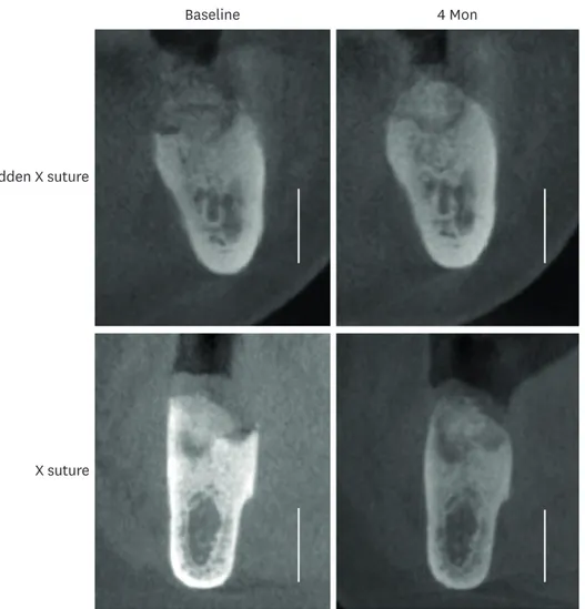 Figure 5. CBCT analysis. The horizontal and vertical dimensional changes were measured by comparing the CBCT  images taken immediately after the graft (baseline) and before implant surgery (4 months)