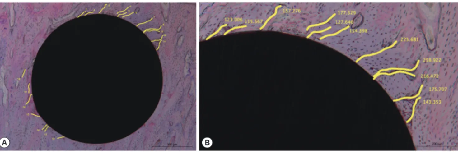 Figure 1. Microcracks in peri-mini-implant bone and the variables measured in this study