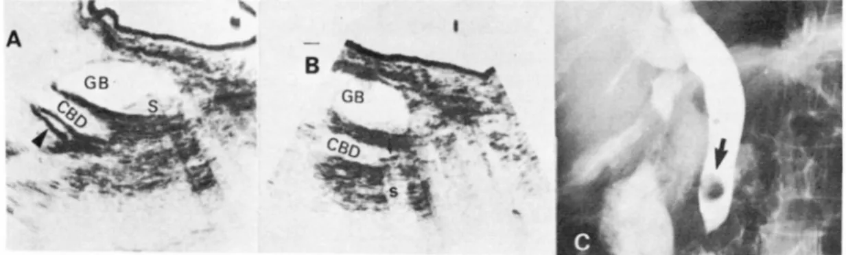 Fig.  4.  Distal  CBD  stone 