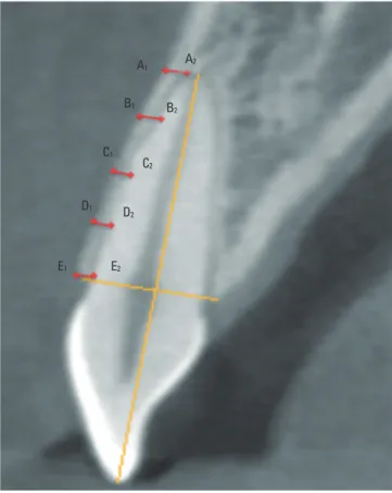 Figure 1. Analyses of buccal bone wall thicknesses in a sagittal cut of a CBCT  scan at the labelled parallel lines
