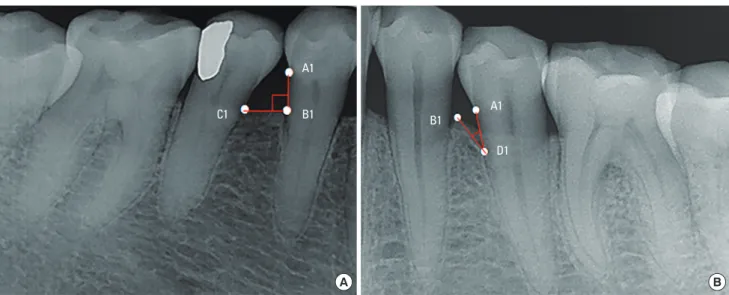 Figure 1. Bone loss at interdental sites was categorized as horizontal or vertical bone loss