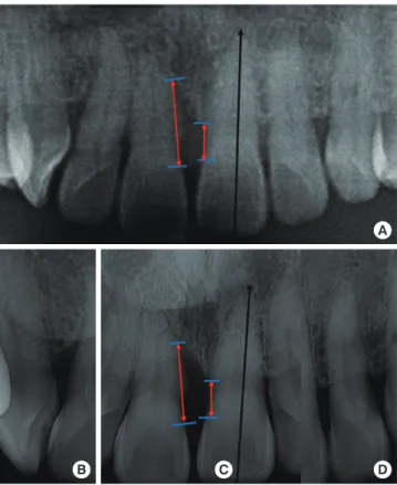 Figure 5. (A) Preoperative and postoperative panoramic radiographs were  used to evaluate the exact bone level, which was reconfirmed with (B-D)  ad-ditional periapical radiographs.