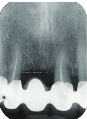 Figure 1. An imaginary line connecting the mesial and the distal ends of the  alveolar crest facing each adjacent tooth was created