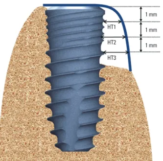 Figure 1. Mid-cross-sectional image of the implant placement site, showing  measurement of horizontal thickness (HT) after augmentation and at the  time of re-entry surgery