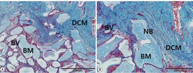 Figure 3. Histological images from the DCM group at the time of re-entry surgery. (A, B) Partially resorbed collagen membrane leaflets exhibiting structural in- in-tegrity and some blood vessels (BVs) were observed