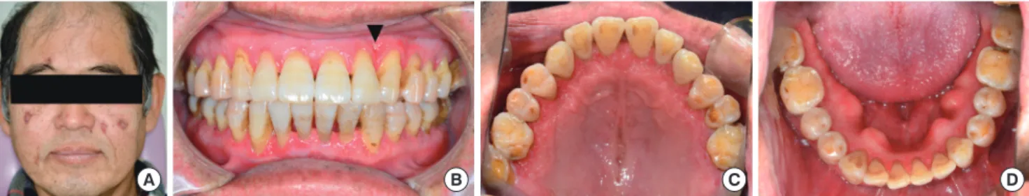 Figure 4. An image showing the dramatic improvement in the patients’ ulcerative facial lesions and gingivae following treatment
