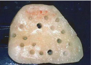 Figure 1. Receptor site before reconstruction. Figure 3. Nonperforated grafts fixed to the host bed.