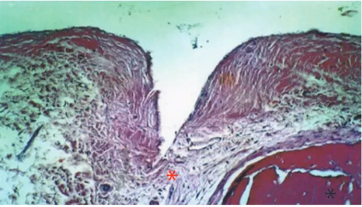 Figure 4. On the inner side of the nonperforated bone graft, observations of  immature bone, large trabecular spaces, and some areas of newly formed bone  is possible (H&amp;E, ×250)
