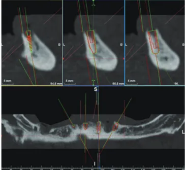 Figure 10. Accuracy assessments in the lower jaw between planned (red) and  real (green) implant positions.