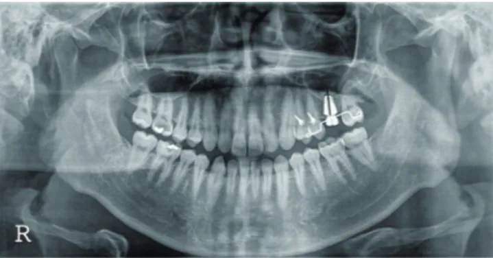 Figure 1. The vertical distance from the alveolar ridge to the most inferior si- si-nus floor at the projected implant placement site was 7.45 mm in this  specif-ic panoramspecif-ic radiograph before the implant surgery (black line)