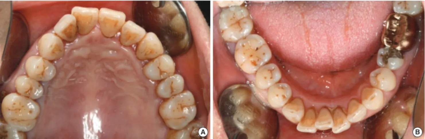 Figure 5. Clinical photographs of case 1 after chemotherapy (A: occlusal view of the maxilla; B: occlusal view of the mandible).