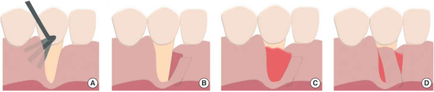 Figure 1. Surgical technique of modified laterally positioned flap combined with subepithelial connective tissue graft placement