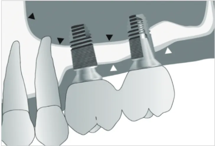 Figure 1. A schematic diagram of implant surgery. The black arrow- heads indicate the Schneiderian membrane, and the white  arrow-heads represent the periosteum