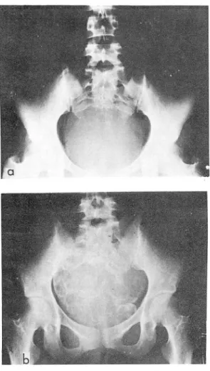 Fig.  6.  Malignant  giant cell  tumor  in  distal tibia. 