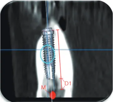 Figure 2. Measurement of D2. D2 was the distance from the im- im-plant apex to the anatomic structure in postsurgical cone-beam  computed tomography