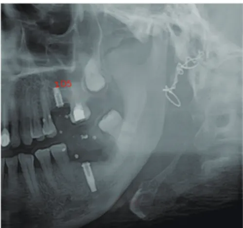 Figure 5. Measurement of D5. D5 was the distance from the implant  apex to the anatomic structure in postsurgical digital panoramic  ra-diography.