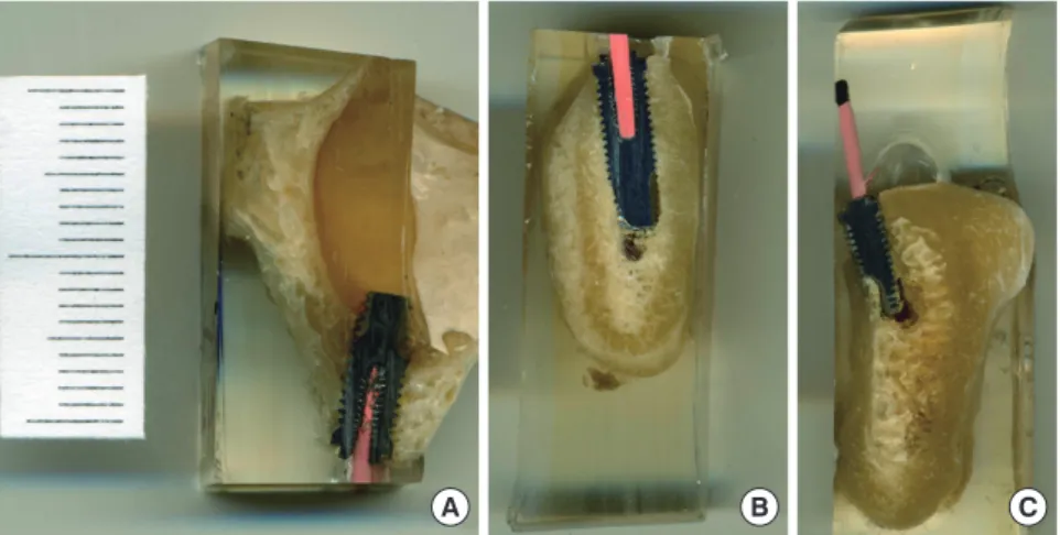 Figure 6. Some critical errors. (A) Maxillary- Maxillary-sinus invasion, (B) mandibular-canal  inva-sion, and (C) lingual-plate perforation.