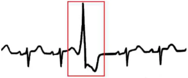 Fig.  2.  Illustration  of  Premature  Ventricular  Contraction  Arrhythmia  Beat 심실조기수축 부정맥 리듬은 별다른 심장병 증상이 없는 건강한  사람에게서 발생하는 경우 특별히 치료가 필요가 없다고 알려져  있지만, 실제로는 심실조기수축 부정맥이 심장질환들과 연관성이  있고[2, 3] 특히 심근경색 또는 심혈관계 질환이 진행되고 있는  환자의  경우는  생명을  위협할  수  있는  심실빈맥