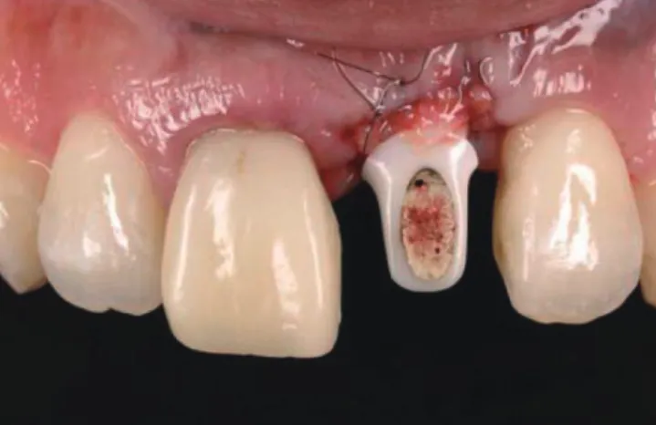 Figure 4. Intraoral appearance immediately after the first subepithe- subepithe-lial connective tissue graft