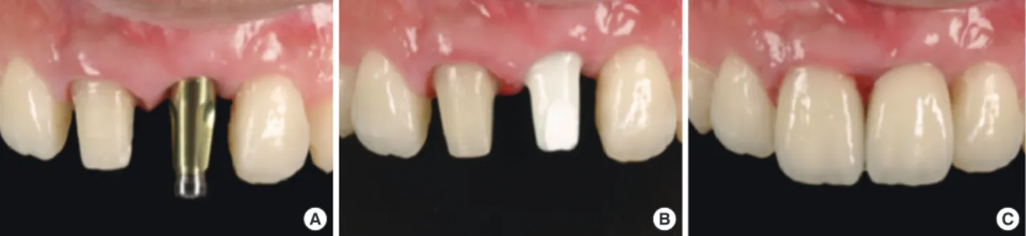 Figure 7. Nine months after the second SCTG. Sufficient soft tissue  regeneration was achieved and the marginal soft tissue level was  stable and esthetically satisfactory.