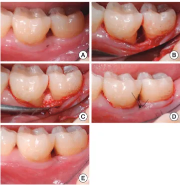 Figure 2. Treatment of an intrabony defect with biphasic calcium  phosphate (BCP) on the distal aspect of an lower left first molar
