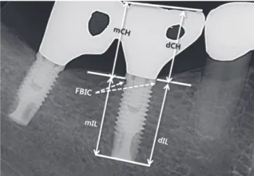 Figure 1.  Formula for calculation of crown-to-implant (C/I) ratio. 