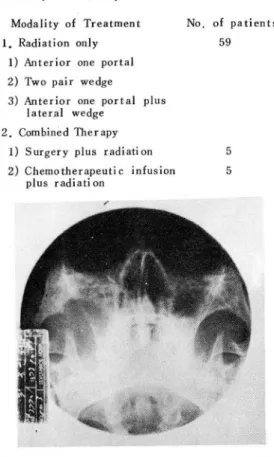 Fig.  4 - B.  Two  months  after  operation  film  shows  no  maxillary  hazines s  and  no  further  bony  destruction  on  water' s  proj ection Fig