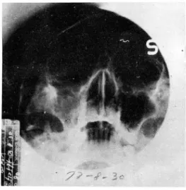 Fig.  6 - B.  Film  t aken  one  month  after  radiation  th erapy  show s  decrease  in  ha ziness  and  abscence  of  bony  invasion
