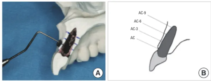 Figure 3. The thickness of the buccal and palatal/lingual plates was  measured with digital calipers (A), and the measurements were  tak-en along the line to the middle of the teeth and parallel to the long  axis of the teeth (B)