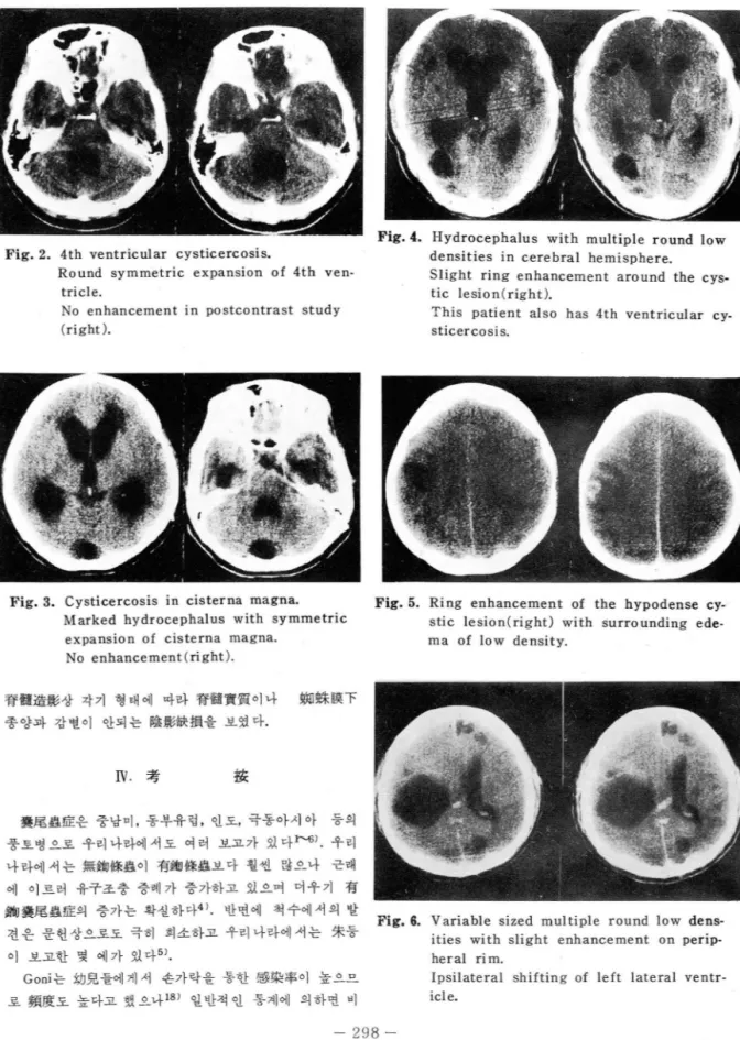 Fig. 3.  Cysticercosis  in  cisterna  magna.  Fig. 5.  Ri ng  enhancement  of  the  hypodense  cy- cy-Marked  h ydrocephalus  with  symmetric  stic  lesion(rig ht )  with  surrounding  