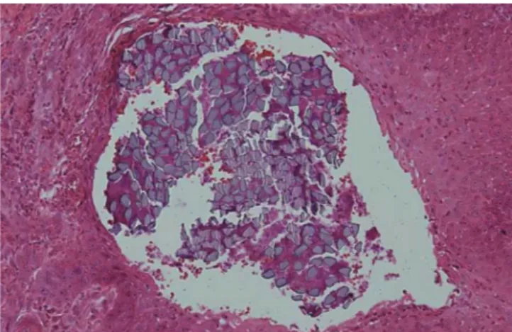 Figure 1.  Silk suture at seven days in buccal oral mucosa. The su- su-ture loop is surrounded by dense inflammatory cell infiltrate and a  zone of inflammatory reaction (H&amp;E staining, original  magnifica-tion ×40).