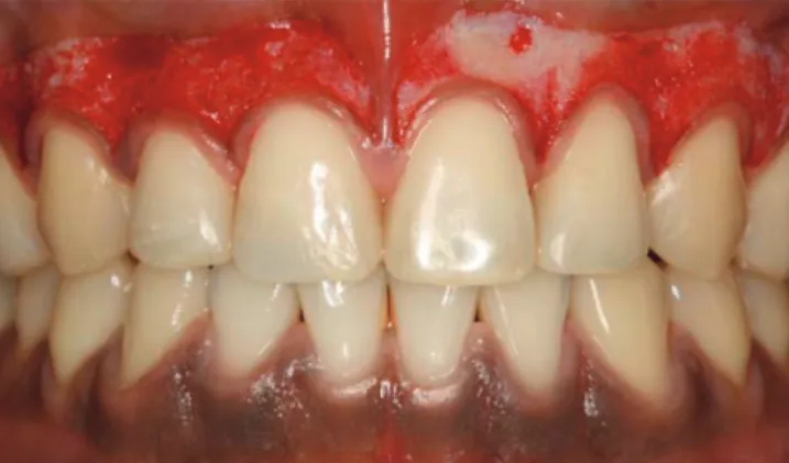Figure 1.  Case 1: pre-operative view. Diffused melanin hyperpig-
