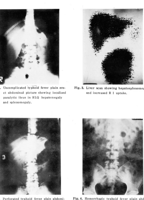 Fig. 1.  Uncornplicated  typhoid  fever  plain  ere- ere-ct  abdorninal  picture  showing  locali zed  paralytic  ileus  in  RLQ  hepato megaly  and  splenornegaly