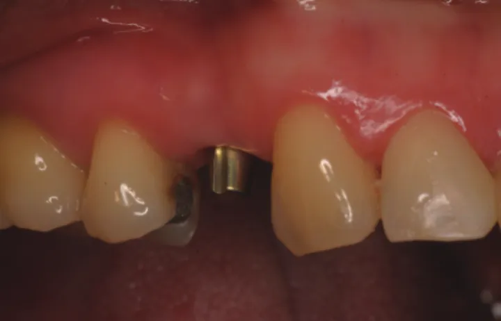 Figure 1.  The maxillary first premolar was extracted and the im- im-plant was placed (A, before extraction; B, imim-plant healed in a  semi-submerged manner).