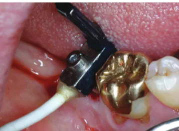 Figure 1.  A small L-shaped transducer that is fastened by a screw to  the implant transmitted vibrations to the fixture.