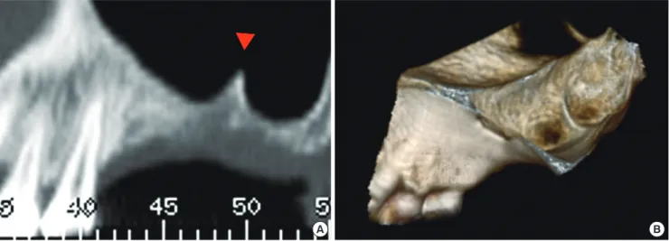 Figure 1. Pre-operative computed tomography. (A) Panoramic view. (B) Three-dimensional reconstructed image