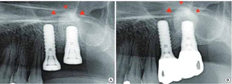 Figure 6. Radiographs on the day of surgery (A) and 27 months after surgery (B). Arrowheads: augmented bone area